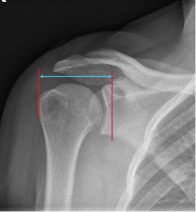 Offset In Radiography Post-Operative Radiographic Assessment - Shoulder Arthroplasty Book
