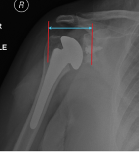 Offset In Radiography Post-Operative Radiographic Assessment - Shoulder Arthroplasty Book
