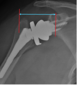 Post-Operative Radiographic Assessment - Shoulder Arthroplasty Book