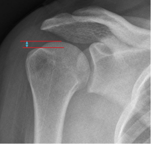 Post-Operative Radiographic Assessment - Shoulder Arthroplasty Book
